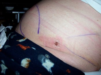 Dave Clingman's post-liposuction swelling and itchy irritations after surgery at Clinica del Pilar, Guadalajara